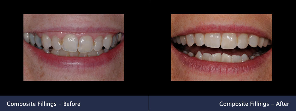 before-after09-composite-fillings | Aarm Dental Group Main Street Dental